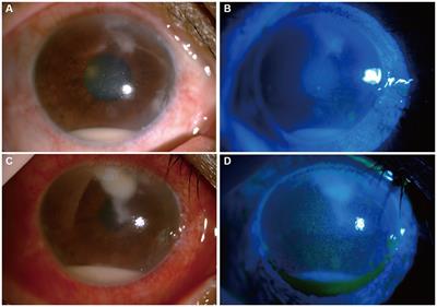 Metagenomic next-generation sequencing to investigate infectious keratitis by Corynespora cassiicola: a case report